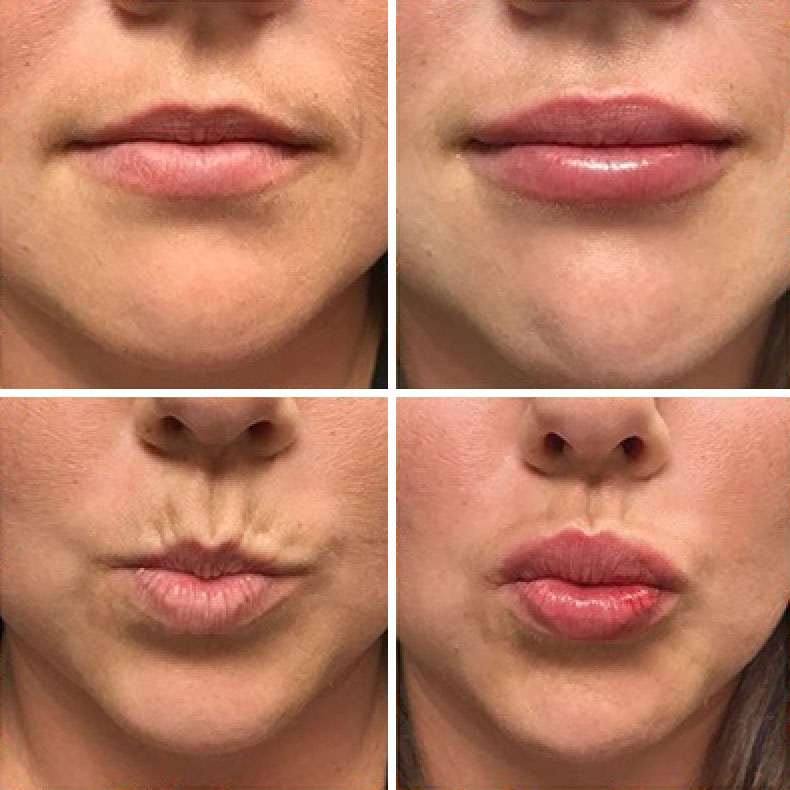 How to Get the Lips You Want: Natural Lip Enhancement