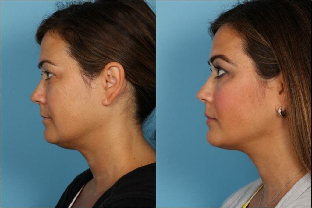 Things to Consider Before Getting a Facelift or Necklift