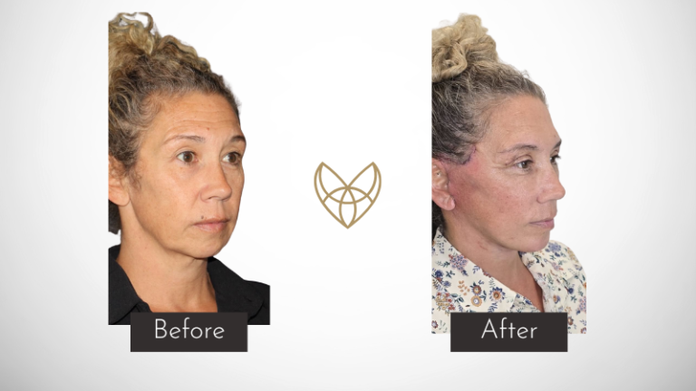 A side by side photo comparison of a blonde woman's before and after post facelift operation with chin liposuction