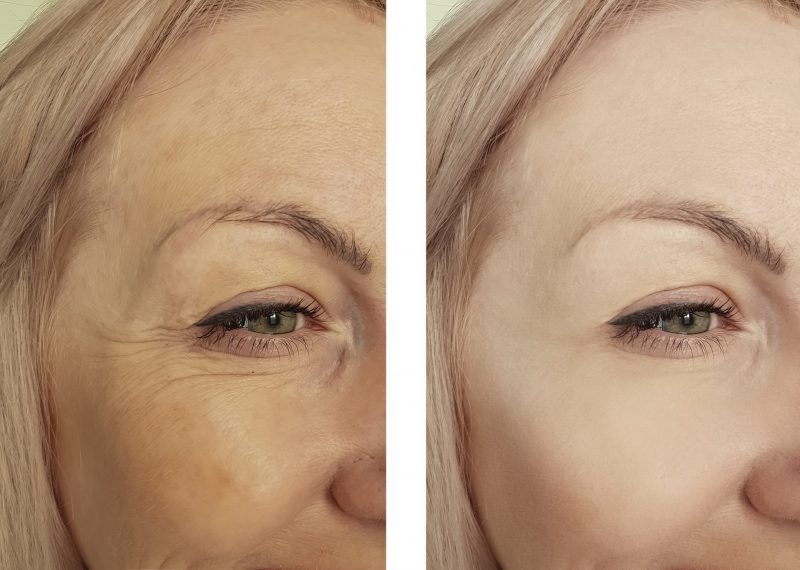 Botox winnipeg before and after