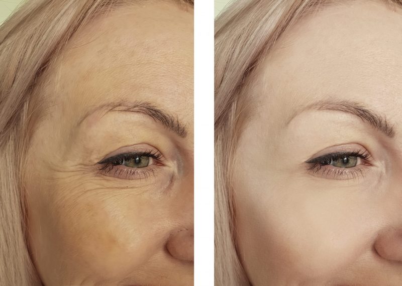 Before and after photo of woman after botox treatments