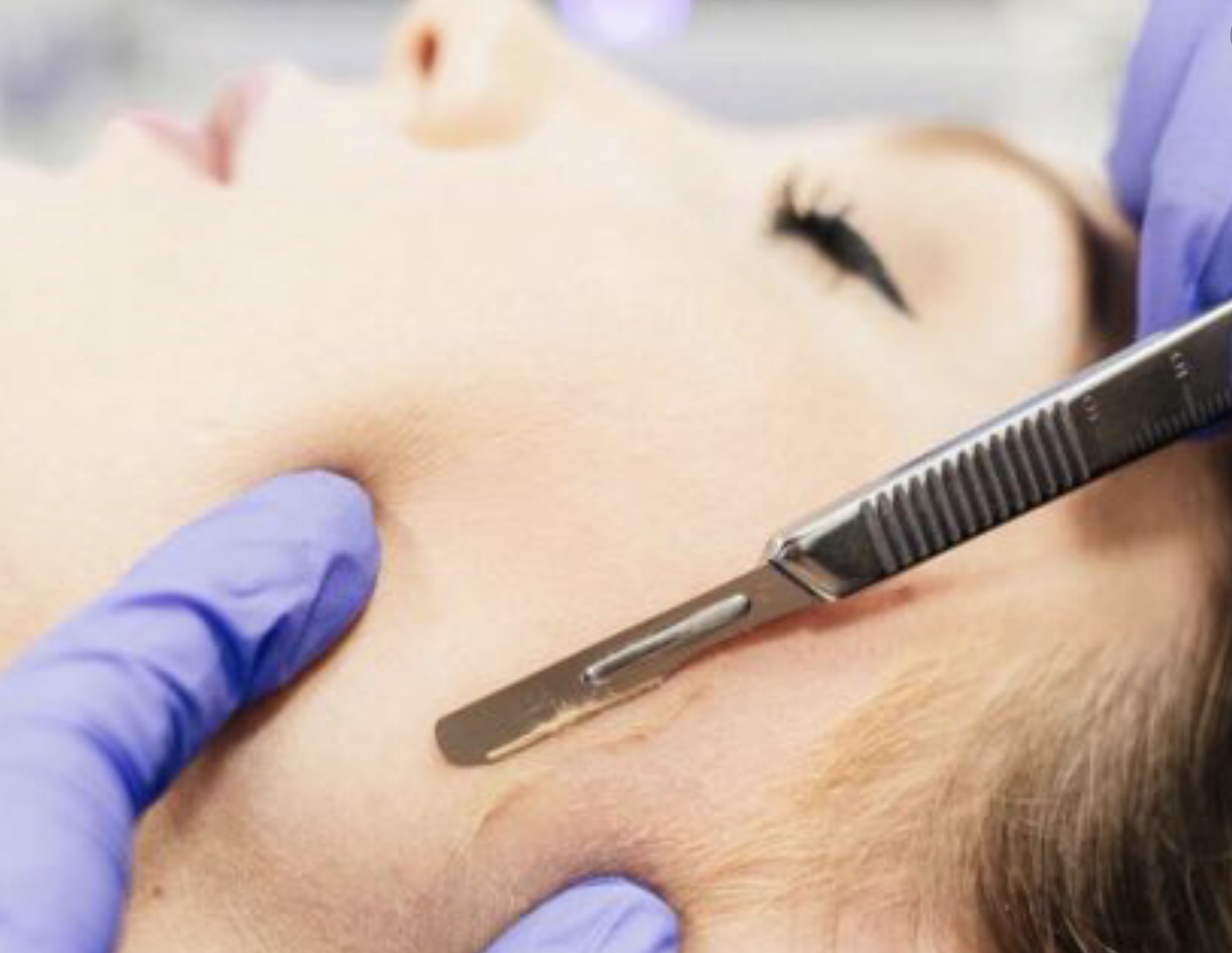 Dermaplaning Winnipeg