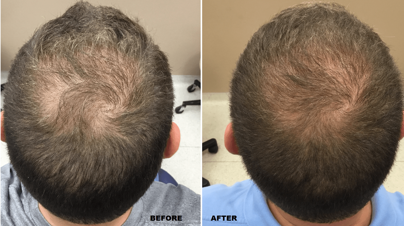 PRP Hair Treatments in Winnipeg at Visage Cosmetic Clinic PRP Hair Treatments in Winnipeg at Visage Cosmetic Clinic