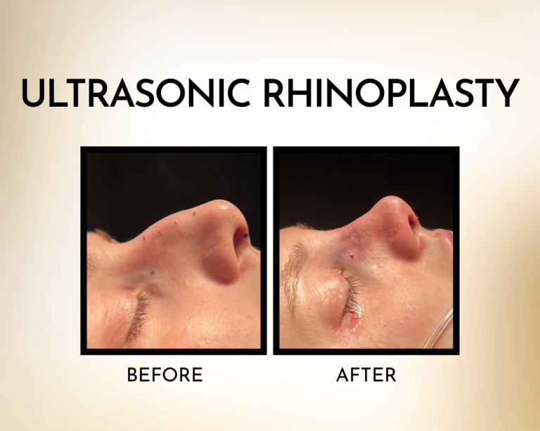 A side by side comparison of an older woman before and after an ultrasonic rhinoplasty.