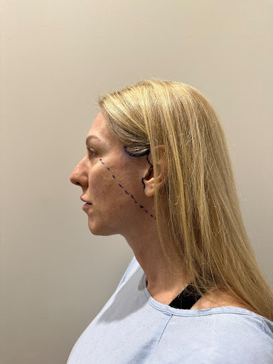 How much does a facelift cost 