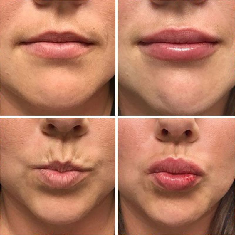 What to Know About Lip Fillers and How to Choose the Best One for You