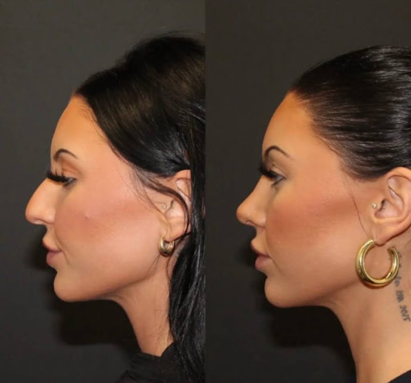 How Much Does a Nose Job Cost? 7 Factors That Influence the Price