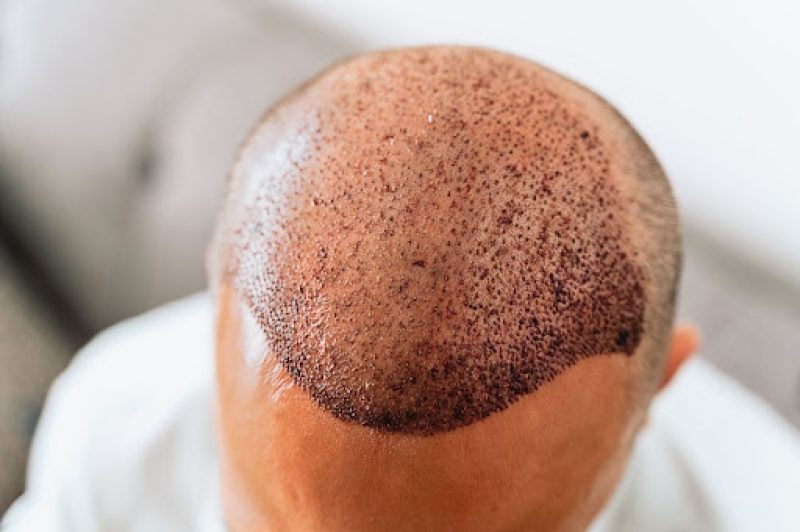 A close-up of a man's scalp after a FUE hair transplant surgery